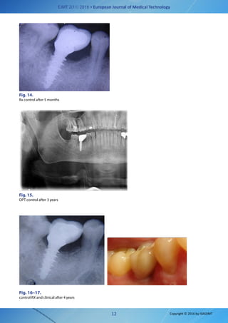 EJMT 2(11) 2016 • European Journal of Medical Technology
12 Copyright © 2016 by ISASDMT
Fig. 14.
Rx control after 5 months
Fig. 15.
OPT control after 3 years
Fig. 16–17.
control RX and clinical after 4 years
 