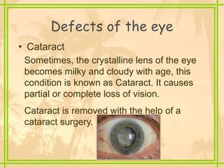Defects of the eye
• Cataract
Sometimes, the crystalline lens of the eye
becomes milky and cloudy with age, this
condition is known as Cataract. It causes
partial or complete loss of vision.
Cataract is removed with the help of a
cataract surgery.
 