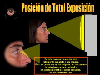 En esta posición la córnea está
totalmente expuesta a ser dañada.
Esto se puede ver en los hogares, en los centros
de estudio estatales y privados
en lugares de trabajo, en las escuelas,
en los cibercafés, etc.
 