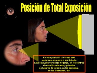 En esta posición la córnea está totalmente expuesta a ser dañada. Esto se puede ver en los hogares, en los centros de estudio estatales y privados en lugares de trabajo, en las escuelas,  en los cibercafés, etc. Posición de Total Exposición  