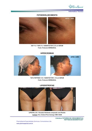 Informativo Técnico
Literatura FATORES DE CRESCIMENTO E
PEPTÍDEOS BIOIDÊNTICOS
®
PharmaSpecial Especialidades Químicas e Farmacêuticas Ltda
www.pharmaspecial.com.br
FOTOENVELHECIMENTO
EGF 1% + TGFß 1% + NANOFACTOR C 2% em SERUM
Fonte: Protocolo DERMAHEAL
HIPERCROMIAS
TGP-2 PEPTÍDEO 4% + NANOFACTOR C 2% em SERUM
Fonte: Protocolo DERMAHEAL
LIPODISTROFIAS
LIPOXYN a 5% + Emulsão Hidratante comparado com Placebo
Cortesia: Dra. Cristina Pires Camargo CRM: 65356
 