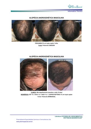 Informativo Técnico
Literatura FATORES DE CRESCIMENTO E
PEPTÍDEOS BIOIDÊNTICOS
®
PharmaSpecial Especialidades Químicas e Farmacêuticas Ltda
www.pharmaspecial.com.br
ALOPÉCIA ANDROGENÉTICA MASCULINA
PROHAIRIN 5% em loção capilar 1x/dia.
Fonte: Protocolo CAREGEN
ALOPÉCIA ANDROGENÉTICA MASCULINA
CLÍNICA: Microagulhamento (sessões a cada 15 dias)
RESIDÊNCIA: IGF 1% + bFGF 1% + VEGF 1% + COPPER PEPTÍDEO 1% em loção capilar
Fonte: Protocolo DERMAHEAL
 