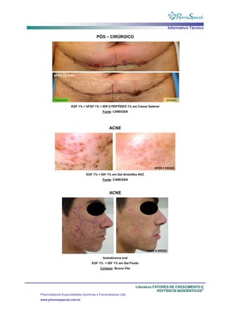 Informativo Técnico
Literatura FATORES DE CRESCIMENTO E
PEPTÍDEOS BIOIDÊNTICOS
®
PharmaSpecial Especialidades Químicas e Farmacêuticas Ltda
www.pharmaspecial.com.br
PÓS – CIRÚRGICO
EGF 1% + bFGF 1% + IDP-2 PEPTÍDEO 1% em Creme Galenol
Fonte: CAREGEN
ACNE
EGF 1% + IGF 1% em Gel Aristoflex AVC
Fonte: CAREGEN
ACNE
Isotretinoina oral
EGF 1% + IGF 1% em Gel Fluido
Cortesia: Buona Vita
 