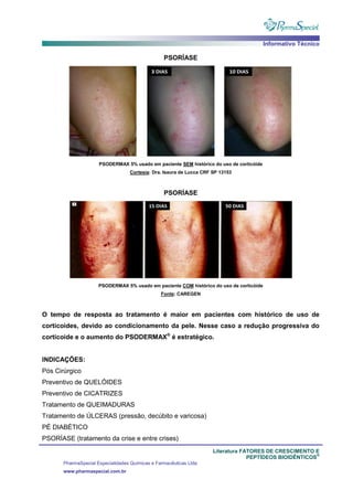 Informativo Técnico
Literatura FATORES DE CRESCIMENTO E
PEPTÍDEOS BIOIDÊNTICOS
®
PharmaSpecial Especialidades Químicas e Farmacêuticas Ltda
www.pharmaspecial.com.br
PSORÍASE
PSODERMAX 5% usado em paciente SEM histórico do uso de corticóide
Cortesia: Dra. Isaura de Lucca CRF SP 13153
PSORÍASE
PSODERMAX 5% usado em paciente COM histórico do uso de corticóide
Fonte: CAREGEN
O tempo de resposta ao tratamento é maior em pacientes com histórico de uso de
corticoides, devido ao condicionamento da pele. Nesse caso a redução progressiva do
corticoide e o aumento do PSODERMAX®
é estratégico.
INDICAÇÕES:
Pós Cirúrgico
Preventivo de QUELÓIDES
Preventivo de CICATRIZES
Tratamento de QUEIMADURAS
Tratamento de ÚLCERAS (pressão, decúbito e varicosa)
PÉ DIABÉTICO
PSORÍASE (tratamento da crise e entre crises)
 