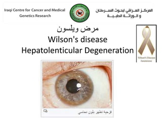 ‫مرض‬
‫ويلسون‬
Wilson's disease
Hepatolenticular Degeneration
 