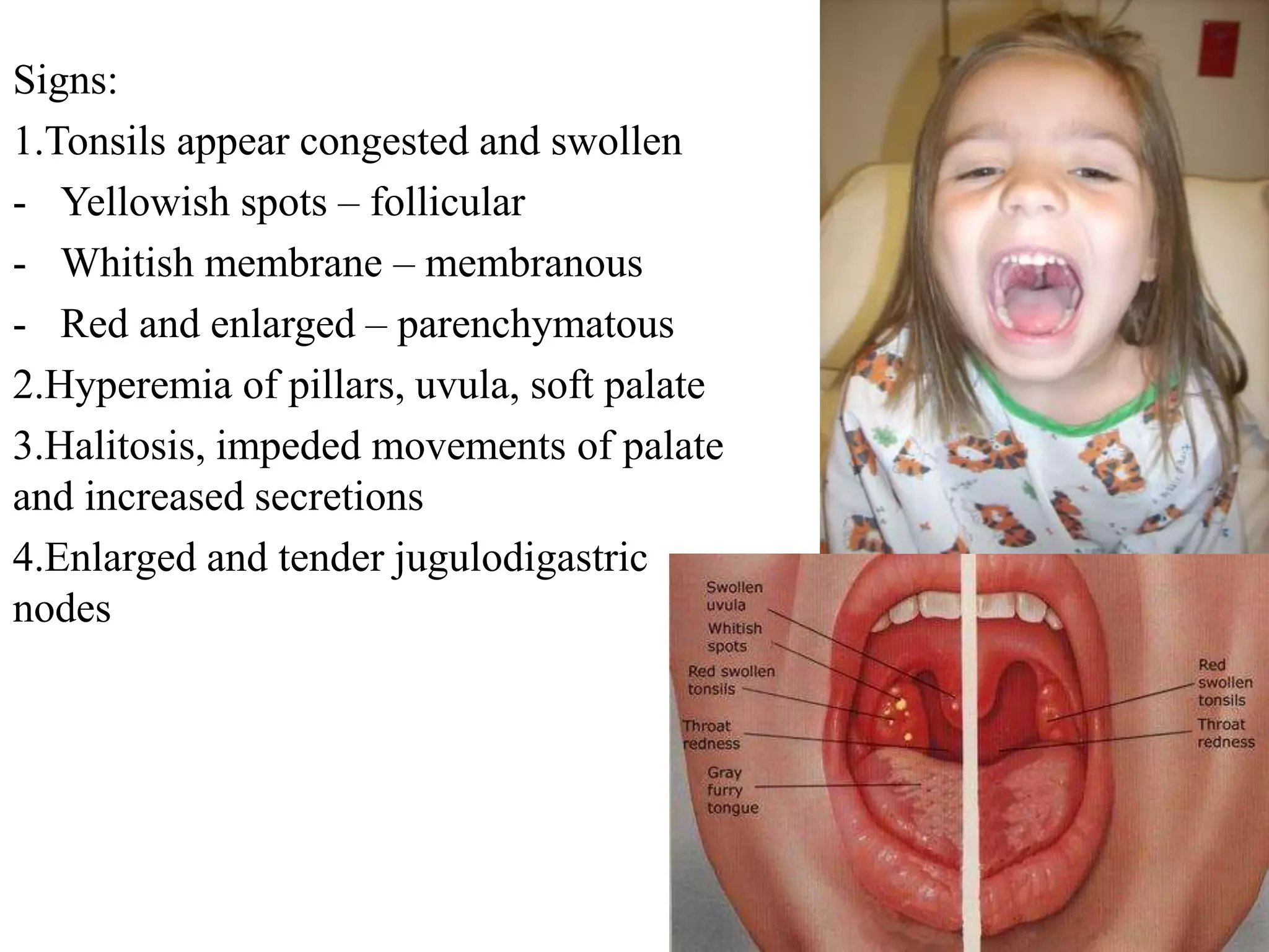 Signs:
1.Tonsils appear congested and swollen
- Yellowish spots – follicular
- Whitish membrane – membranous
- Red and enlarged – parenchymatous
2.Hyperemia of pillars, uvula, soft palate
3.Halitosis, impeded movements of palate
and increased secretions
4.Enlarged and tender jugulodigastric
nodes
 