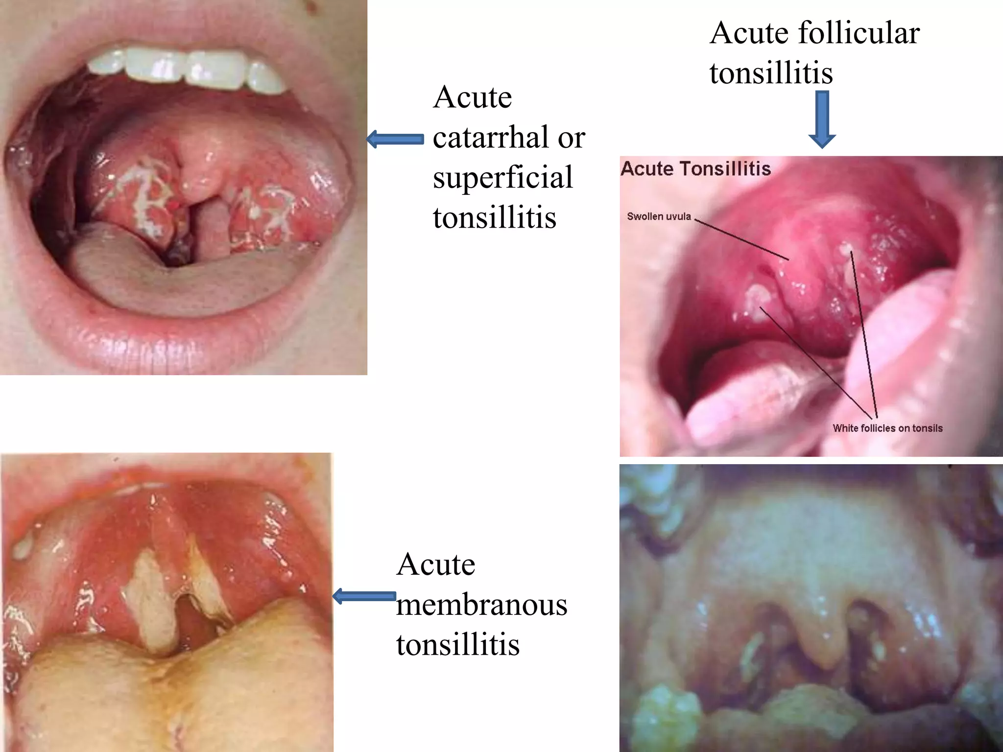 Acute follicular
tonsillitis
Acute
catarrhal or
superficial
tonsillitis
Acute
membranous
tonsillitis
 
