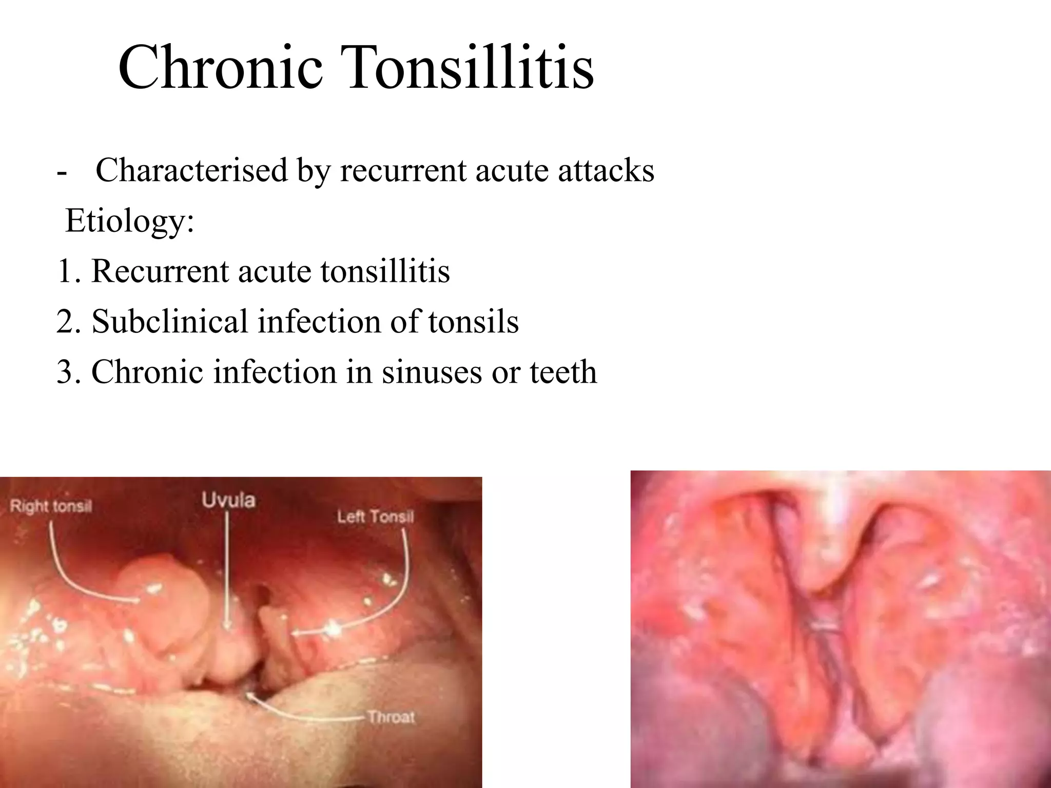 Chronic Tonsillitis
- Characterised by recurrent acute attacks
Etiology:
1. Recurrent acute tonsillitis
2. Subclinical infection of tonsils
3. Chronic infection in sinuses or teeth
 