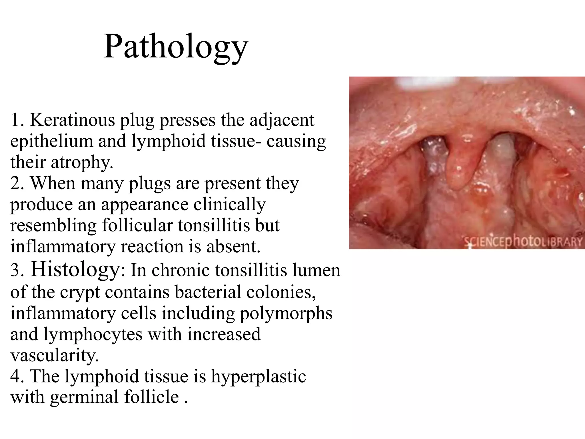 Pathology
1. Keratinous plug presses the adjacent
epithelium and lymphoid tissue- causing
their atrophy.
2. When many plugs are present they
produce an appearance clinically
resembling follicular tonsillitis but
inflammatory reaction is absent.
3. Histology: In chronic tonsillitis lumen
of the crypt contains bacterial colonies,
inflammatory cells including polymorphs
and lymphocytes with increased
vascularity.
4. The lymphoid tissue is hyperplastic
with germinal follicle .
 