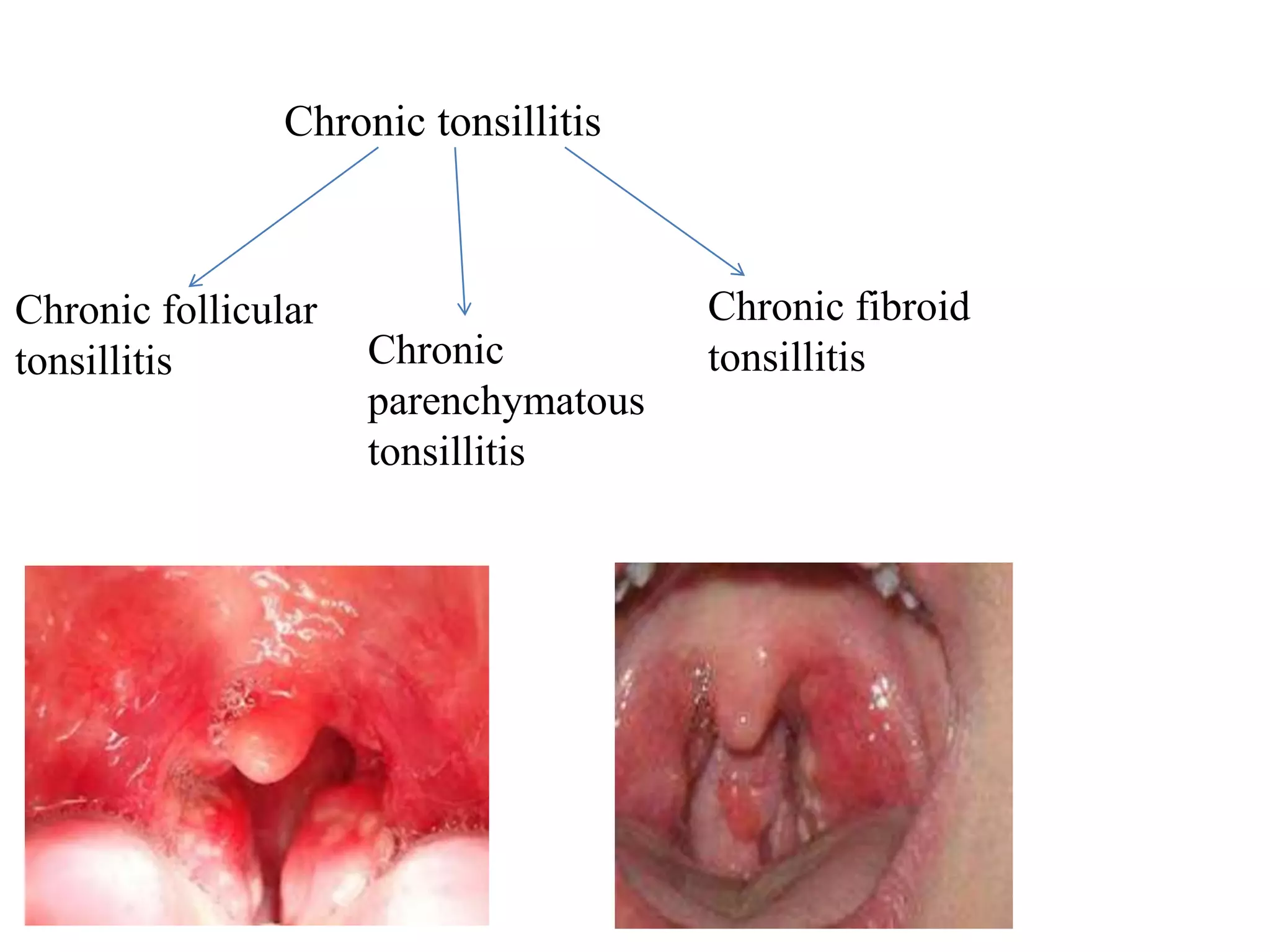 Chronic tonsillitis
Chronic follicular
tonsillitis Chronic
parenchymatous
tonsillitis
Chronic fibroid
tonsillitis
 