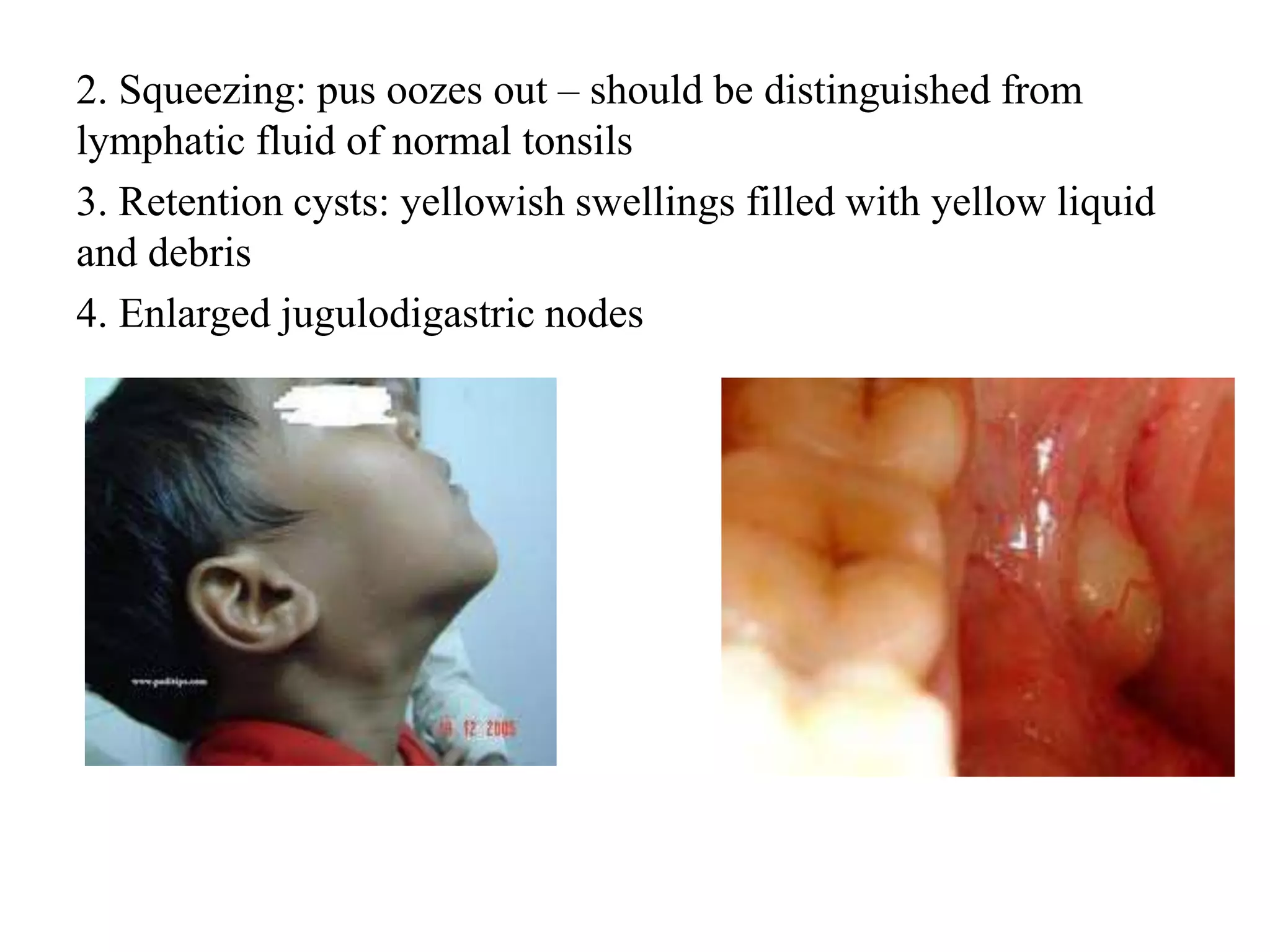 2. Squeezing: pus oozes out – should be distinguished from
lymphatic fluid of normal tonsils
3. Retention cysts: yellowish swellings filled with yellow liquid
and debris
4. Enlarged jugulodigastric nodes
 