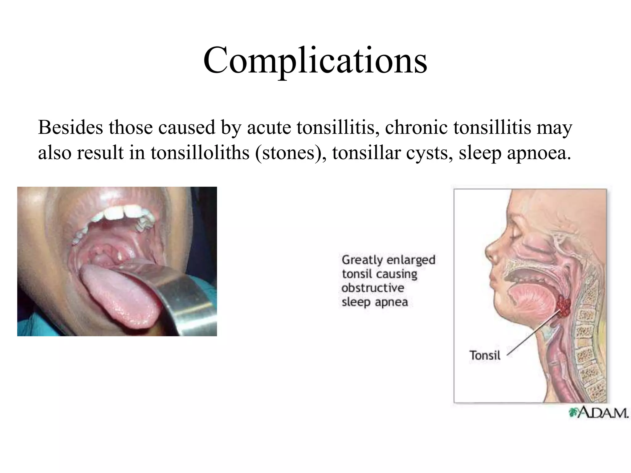 Complications
Besides those caused by acute tonsillitis, chronic tonsillitis may
also result in tonsilloliths (stones), tonsillar cysts, sleep apnoea.
 
