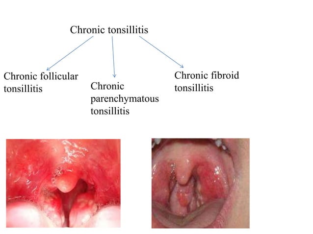 TONSILLITIS | PPTX | Ear, Nose and Throat Conditions | Diseases and ...