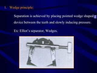 1. Wedge principle:

      Separation is achieved by placing pointed wedge shaped
      device between the teeth and slowly inducing pressure.

      Ex: Elliot’s separator, Wedges.
 