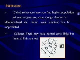 Septic zone

-     Called so because here you find highest population
      of microorganisms, even though dentine is
demineralized its      frame work structure can be
appreciated.

-      Collagen fibers may have normal cross links but
      internal links are lost.
 