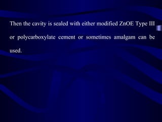 Then the cavity is sealed with either modified ZnOE Type III

or polycarboxylate cement or sometimes amalgam can be

used.
 