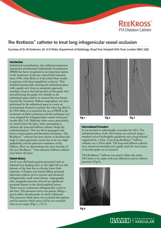 The ReeKross™ catheter to treat long infragenicular vessel occlusion 
Courtesy of Dr. M Anderson, Dr. A D Platts, Department of Radiology, Royal Free Hospital NHS Trust, London NW3 2QG 
Introduction 
Subintimal recanalisation, also called percutaneous 
intentional extraluminal (subintimal) recanalisation 
(PIER) has been recognised as an important option 
in the treatment of chronic critical limb ischemia 
since 1990, when Bolia et al described their results 
in patients with femoropopliteal occlusion. This 
entailed intentionally entering the subintimal space 
with a guide wire from an antegrade approach, 
creating a loop in the lead portion of the guide wire 
and advancing the guide wire distally in the 
subintimal space until it re-entered the true lumen 
beyond the occlusion. Balloon angioplasty was then 
performed in the subintimal space to create an 
extraluminal channel to perfuse the lower leg (Ref 1). 
In 1994, Bolia et al reported the use of PIER in the 
treatment of tibial occlusions and this technique was 
soon adopted for infrageniculate vessels with good 
results (Ref 2-4). Difficulty often arises, particularly 
in vessels below the knee, when attempting to 
advance the loop and balloon catheter along the 
subintimal plane. This can fail to propagate and 
lead to extravasation and thrombus formation. The 
ReeKross™ catheter has been shown to facilitate this 
stage in supra-genicular vessels due to its very high 
pushability and the puncture-resistance of the 
balloon. Here we demonstrate the same benefits of 
the new ReeKross™ 3mm diameter balloon catheter 
used below the knee. 
Patient History 
An 81 year old female patient presented with an 
infected non-healing ulcer on the right 4th toe and 
dorsum of the foot due to chronic lower limb 
ischemia. A Duplex scan found diffuse proximal 
atheroma without severe stenosis and advanced 
infragenicular small vessel disease. Angiography 
after antegrade puncture showed no significant 
proximal disease to the distal popliteal artery. 
There was no continuous infragenicular vessel to 
the foot. The peroneal artery was patent, filling a 
good calibre dorsalis pedis via distal collaterals. 
The posterior tibial artery was occluded throughout 
and the anterior tibial artery (ATA) was occluded 
close to its origin (Figs 1, 2 & 3). 
Fig 1 Fig 2 
Fig 1 Fig 2 Fig 3 
Interventional Procedure 
It was decided to subintimally recanalise the ATA. The 
subintimal plane of the ATA stump was entered using a 
standard curved hydrophilic guidewire and a loop formed 
supported by a 3mm, 12cm long ReeKross™ balloon 
catheter on a 110cm shaft. The loop and balloon catheter 
were advanced smoothly and rapidly until the true lumen 
of dorsalis pedis was re-entered. 
The ReeKross™ balloon was used to dilate the entire 
ATA back to its origin with easy dilatation and no balloon 
puncture (Fig 4). 
Fig 4 
 