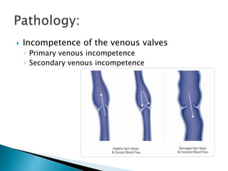 Venous Diseases, Varicose Veins | PPT
