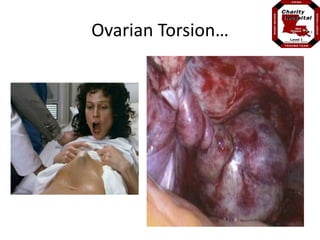 Ovarian Torsion… 
 