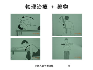 18
物理治療 + 藥物
少數人要手術治療
 