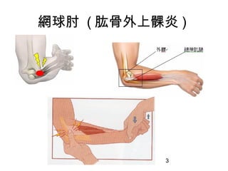 3
網球肘 ( 肱骨外上髁炎 )
 