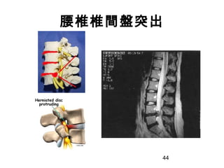 44
腰椎椎間盤突出
 