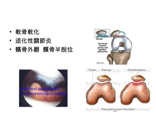50
• 軟骨軟化
• 退化性關節炎
• 髕骨外翻 髕骨半脫位
 