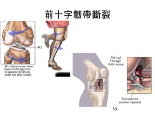 53
前十字韌帶斷裂
 