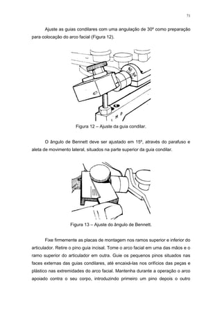 71
Ajuste as guias condilares com uma angulação de 30º como preparação
para colocação do arco facial (Figura 12).
Figura 12 – Ajuste da guia condilar.
O ângulo de Bennett deve ser ajustado em 15º, através do parafuso e
aleta de movimento lateral, situados na parte superior da guia condilar.
Figura 13 – Ajuste do ângulo de Bennett.
Fixe firmemente as placas de montagem nos ramos superior e inferior do
articulador. Retire o pino guia incisal. Tome o arco facial em uma das mãos e o
ramo superior do articulador em outra. Guie os pequenos pinos situados nas
faces externas das guias condilares, até encaixá-las nos orifícios das peças e
plástico nas extremidades do arco facial. Mantenha durante a operação o arco
apoiado contra o seu corpo, introduzindo primeiro um pino depois o outro
 