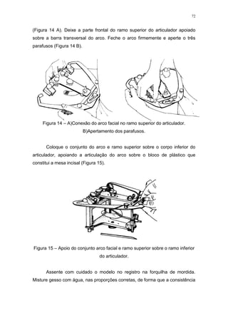 72
(Figura 14 A). Deixe a parte frontal do ramo superior do articulador apoiado
sobre a barra transversal do arco. Feche o arco firmemente e aperte o três
parafusos (Figura 14 B).
Figura 14 – A)Conexão do arco facial no ramo superior do articulador.
B)Apertamento dos parafusos.
Coloque o conjunto do arco e ramo superior sobre o corpo inferior do
articulador, apoiando a articulação do arco sobre o bloco de plástico que
constitui a mesa incisal (Figura 15).
Figura 15 – Apoio do conjunto arco facial e ramo superior sobre o ramo inferior
do articulador.
Assente com cuidado o modelo no registro na forquilha de mordida.
Misture gesso com água, nas proporções corretas, de forma que a consistência
 