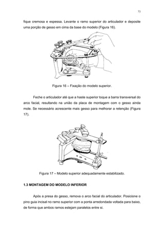 73
fique cremosa e espessa. Levante o ramo superior do articulador e deposite
uma porção de gesso em cima da base do modelo (Figura 16).
Figura 16 – Fixação do modelo superior.
Feche o articulador até que a haste superior toque a barra transversal do
arco facial, resultando na união da placa de montagem com o gesso ainda
mole. Se necessário acrescente mais gesso para melhorar a retenção (Figura
17).
Figura 17 – Modelo superior adequadamente estabilizado.
1.3 MONTAGEM DO MODELO INFERIOR
Após a presa do gesso, remova o arco facial do articulador. Posicione o
pino guia incisal no ramo superior com a ponta arredondada voltada para baixo,
de forma que ambos ramos estejam paralelos entre si.
 