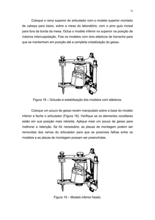 74
Coloque o ramo superior do articulador com o modelo superior montado
de cabeça para baixo, sobre a mesa do laboratório, com o pino guia incisal
para fora da borda da mesa. Oclua o modelo inferior no superior na posição de
máxima intercuspidação. Fixe os modelos com dois elásticos de borracha para
que se mantenham em posição até a completa cristalização do gesso.
Figura 18 – Oclusão e estabilização dos modelos com elásticos.
Coloque um pouco de gesso recém manipulado sobre a base do modelo
inferior e feche o articulador (Figura 19). Verifique se os elementos condilares
estão em sua posição mais retraída. Aplique mais um pouco de gesso para
melhorar a retenção. Se for necessário, as placas de montagem podem ser
removidas dos ramos do articulador para que as possíveis falhas entre os
modelos e as placas de montagem possam ser preenchidas.
Figura 19 – Modelo inferior fixado.
 