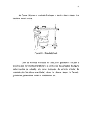 75
Na Figura 20 temos o resultado final após o término da montagem dos
modelos no articulador.
Figura 20 – Resultado final.
Com os modelos montados no articulador poderemos estudar a
dinâmica dos movimentos mandibulares e a influência das variações de alguns
determinantes da oclusão, tais como: inclinação da vertente articular da
cavidade glenóide (fossa mandibular), altura de cúspide, ângulo de Bennett,
guia incisal, guia canina, distância intercondilar, etc.
 