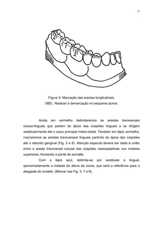 77
Figura 3- Marcação das arestas longitudinais.
OBS.: Realizar a demarcação no esquema acima.
Ainda em vermelho delimitaremos as arestas transversais
ocluso-linguais que partem do ápice das cúspides linguais e se dirigem
vestibularmente até o sulco principal mésio-distal. Também em lápis vermelho,
marcaremos as arestas transversais linguais partindo do ápice das cúspides
até o rebordo gengival (Fig. 5 e 6). Atenção especial deverá ser dada à união
entre a aresta transversal oclusal das cúspides mesiopalatinas nos molares
superiores, formando a ponte de esmalte.
Com o lápis azul, delimita-se por vestibular e lingual,
aproximadamente a metade da altura da coroa, que será a referência para o
desgaste do modelo. (Marcar nas Fig. 3, 7 e 8).
 