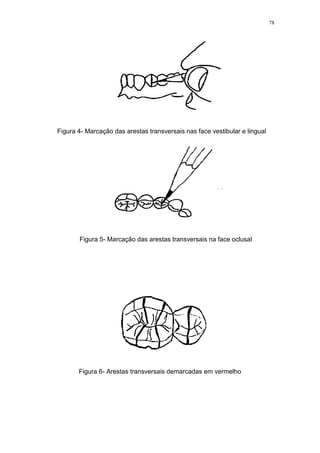 78
Figura 4- Marcação das arestas transversais nas face vestibular e lingual
Figura 5- Marcação das arestas transversais na face oclusal
Figura 6- Arestas transversais demarcadas em vermelho
 