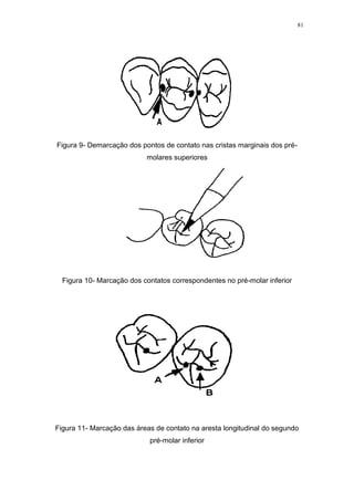 81
Figura 9- Demarcação dos pontos de contato nas cristas marginais dos pré-
molares superiores
Figura 10- Marcação dos contatos correspondentes no pré-molar inferior
Figura 11- Marcação das áreas de contato na aresta longitudinal do segundo
pré-molar inferior
 