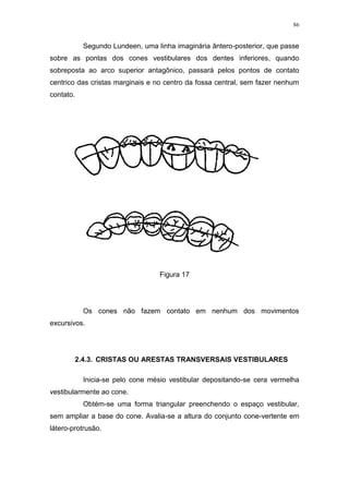 86
Segundo Lundeen, uma linha imaginária ântero-posterior, que passe
sobre as pontas dos cones vestibulares dos dentes inferiores, quando
sobreposta ao arco superior antagônico, passará pelos pontos de contato
centrico das cristas marginais e no centro da fossa central, sem fazer nenhum
contato.
Figura 17
Os cones não fazem contato em nenhum dos movimentos
excursivos.
2.4.3. CRISTAS OU ARESTAS TRANSVERSAIS VESTIBULARES
Inicia-se pelo cone mésio vestibular depositando-se cera vermelha
vestibularmente ao cone.
Obtém-se uma forma triangular preenchendo o espaço vestibular,
sem ampliar a base do cone. Avalia-se a altura do conjunto cone-vertente em
látero-protrusão.
 