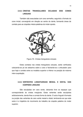 90
2.4.8. CRISTAS TRIANGULARES OCLUSAIS DOS CONES
LINGUAIS
Também são executadas com cera vermelha, seguindo o formato do
cone inicial, convergindo em direção ao centro do dente, formando áreas de
contato para as cúspides mésio-palatinas do molar oposto.
Figura 18 - Cristas triangulares oclusais
Estes contatos nas cristas triangulares oclusais, serão verificados
colocando-se pó de estearina sobre a cera e fechando-se o articulador para
que haja o contato entre os modelos superior e inferior na posição de máxima
inter-cuspidação.
2.4.9. VERTENTES LONGITUDINAIS MESIAL E DISTAL DAS
CÚSPIDES LINGUAIS
São esculpidas em cera verde, deixando livre os espaços que
corresponderão às cristas marginais. Estas vertentes serão esculpidas
arbitrariamente, dando-Ihes a correta forma do dente. O sulco lingual é formado
na junção das vertentes de cera verde mesial e distal, lembrando-se que este
sulco é a trajetória do movimento de trabalho da cúspide palatina do molar
superior.
 