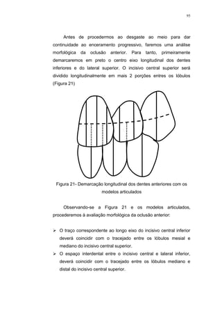 95
Antes de procedermos ao desgaste ao meio para dar
continuidade ao enceramento progressivo, faremos uma análise
morfológica da oclusão anterior. Para tanto, primeiramente
demarcaremos em preto o centro eixo longitudinal dos dentes
inferiores e do lateral superior. O incisivo central superior será
dividido longitudinalmente em mais 2 porções entres os lóbulos
(Figura 21)
Figura 21- Demarcação longitudinal dos dentes anteriores com os
modelos articulados
Observando-se a Figura 21 e os modelos articulados,
procederemos à avaliação morfológica da oclusão anterior:
 O traço correspondente ao longo eixo do incisivo central inferior
deverá coincidir com o tracejado entre os lóbulos mesial e
mediano do incisivo central superior.
 O espaço interdental entre o incisivo central e lateral inferior,
deverá coincidir com o tracejado entre os lóbulos mediano e
distal do incisivo central superior.
 