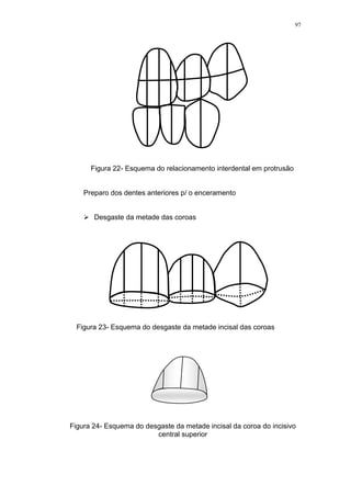 97
Figura 22- Esquema do relacionamento interdental em protrusão
Preparo dos dentes anteriores p/ o enceramento
 Desgaste da metade das coroas
Figura 23- Esquema do desgaste da metade incisal das coroas
Figura 24- Esquema do desgaste da metade incisal da coroa do incisivo
central superior
 