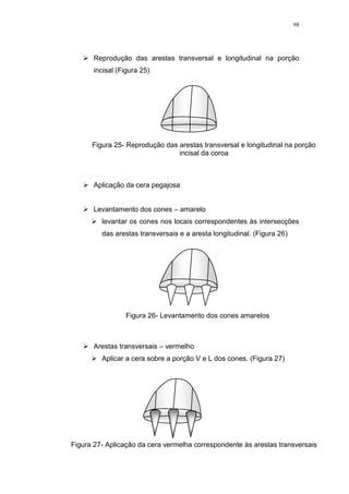 98
 Reprodução das arestas transversal e longitudinal na porção
incisal (Figura 25)
 Aplicação da cera pegajosa
 Levantamento dos cones – amarelo
 levantar os cones nos locais correspondentes às intersecções
das arestas transversais e a aresta longitudinal. (Figura 26)
 Arestas transversais – vermelho
 Aplicar a cera sobre a porção V e L dos cones. (Figura 27)
Figura 25- Reprodução das arestas transversal e longitudinal na porção
incisal da coroa
Figura 26- Levantamento dos cones amarelos
Figura 27- Aplicação da cera vermelha correspondente às arestas transversais
 