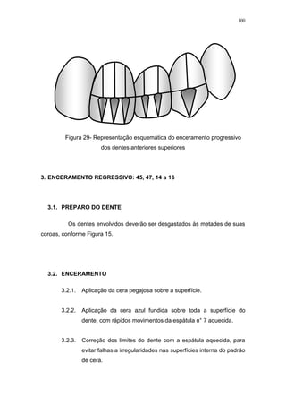 100
Figura 29- Representação esquemática do enceramento progressivo
dos dentes anteriores superiores
3. ENCERAMENTO REGRESSIVO: 45, 47, 14 a 16
3.1. PREPARO DO DENTE
Os dentes envolvidos deverão ser desgastados às metades de suas
coroas, conforme Figura 15.
3.2. ENCERAMENTO
3.2.1. Aplicação da cera pegajosa sobre a superfície.
3.2.2. Aplicação da cera azul fundida sobre toda a superfície do
dente, com rápidos movimentos da espátula n° 7 aquecida.
3.2.3. Correção dos limites do dente com a espátula aquecida, para
evitar falhas a irregularidades nas superfícies interna do padrão
de cera.
 