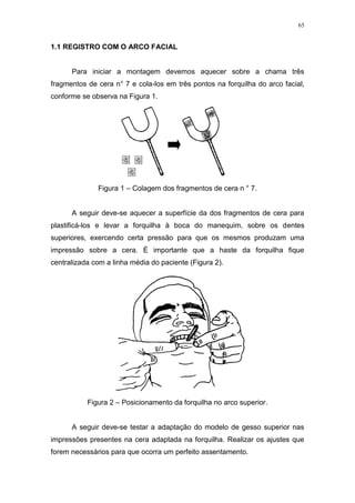 65
1.1 REGISTRO COM O ARCO FACIAL
Para iniciar a montagem devemos aquecer sobre a chama três
fragmentos de cera n° 7 e cola-los em três pontos na forquilha do arco facial,
conforme se observa na Figura 1.
Figura 1 – Colagem dos fragmentos de cera n ° 7.
A seguir deve-se aquecer a superfície da dos fragmentos de cera para
plastificá-los e levar a forquilha à boca do manequim, sobre os dentes
superiores, exercendo certa pressão para que os mesmos produzam uma
impressão sobre a cera. É importante que a haste da forquilha fique
centralizada com a linha média do paciente (Figura 2).
Figura 2 – Posicionamento da forquilha no arco superior.
A seguir deve-se testar a adaptação do modelo de gesso superior nas
impressões presentes na cera adaptada na forquilha. Realizar os ajustes que
forem necessários para que ocorra um perfeito assentamento.
 