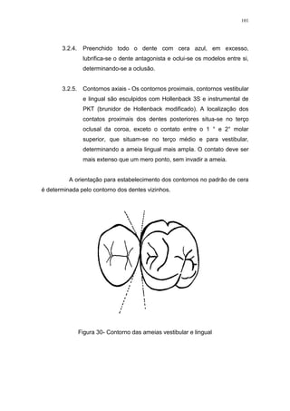 101
3.2.4. Preenchido todo o dente com cera azul, em excesso,
lubrifica-se o dente antagonista e oclui-se os modelos entre si,
determinando-se a oclusão.
3.2.5. Contornos axiais - Os contornos proximais, contornos vestibular
e lingual são esculpidos com Hollenback 3S e instrumental de
PKT (brunidor de Hollenback modificado). A localização dos
contatos proximais dos dentes posteriores situa-se no terço
oclusal da coroa, exceto o contato entre o 1 ° e 2° molar
superior, que situam-se no terço médio e para vestibular,
determinando a ameia lingual mais ampla. O contato deve ser
mais extenso que um mero ponto, sem invadir a ameia.
A orientação para estabelecimento dos contornos no padrão de cera
é determinada pelo contorno dos dentes vizinhos.
Figura 30- Contorno das ameias vestibular e lingual
 