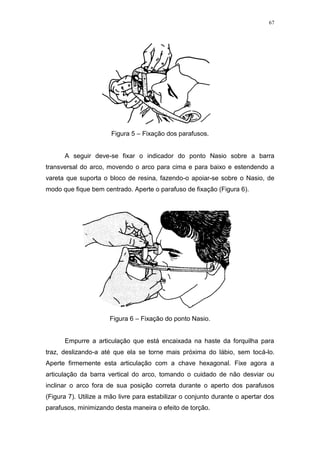 67
Figura 5 – Fixação dos parafusos.
A seguir deve-se fixar o indicador do ponto Nasio sobre a barra
transversal do arco, movendo o arco para cima e para baixo e estendendo a
vareta que suporta o bloco de resina, fazendo-o apoiar-se sobre o Nasio, de
modo que fique bem centrado. Aperte o parafuso de fixação (Figura 6).
Figura 6 – Fixação do ponto Nasio.
Empurre a articulação que está encaixada na haste da forquilha para
traz, deslizando-a até que ela se torne mais próxima do lábio, sem tocá-lo.
Aperte firmemente esta articulação com a chave hexagonal. Fixe agora a
articulação da barra vertical do arco, tomando o cuidado de não desviar ou
inclinar o arco fora de sua posição correta durante o aperto dos parafusos
(Figura 7). Utilize a mão livre para estabilizar o conjunto durante o apertar dos
parafusos, minimizando desta maneira o efeito de torção.
 