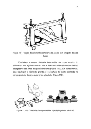 70
Figura 10 – Fixação dos elementos condilares de acordo com o registro do arco
facial.
Estabeleça a mesma distância intercondilar no corpo superior do
articulador. Em algumas marcas, isso é realizado acrescentando ou tirando
espaçadores dos pinos dos guias condilares (Figura 11 A). Em outras marcas,
esta regulagem é realizada girando-se o parafuso de ajuste localizado na
porção posterior do ramo superior do articulador (Figura 11B).
Figura 11 – A) Colocação de espaçadores. B) Regulagem do parafuso.
 