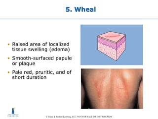 Wheals Examples Diagnostic and Descriptive Terminology for Oral Pathology | PDF