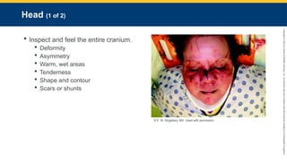 Copyright
©
2023
by
Jones
&
Bartlett
Learning,
LLC,
an
Ascend
Learning
Company
and
the
American
Academy
of
Orthopaedic
Surgeons.
Head (1 of 2)
 Inspect and feel the entire cranium.
 Deformity
 Asymmetry
 Warm, wet areas
 Tenderness
 Shape and contour
 Scars or shunts
© E. M. Singletary, MD. Used with permission.
 