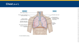 Copyright
©
2023
by
Jones
&
Bartlett
Learning,
LLC,
an
Ascend
Learning
Company
and
the
American
Academy
of
Orthopaedic
Surgeons.
Chest (6 of 7)
© Jones & Bartlett Learning.
 