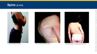 Copyright
©
2023
by
Jones
&
Bartlett
Learning,
LLC,
an
Ascend
Learning
Company
and
the
American
Academy
of
Orthopaedic
Surgeons.
Spine (2 of 4)
© Jones & Bartlett Learning. © Dr. P. Marazzi/Science Source. © Southern Illinois University/Science Source.
 